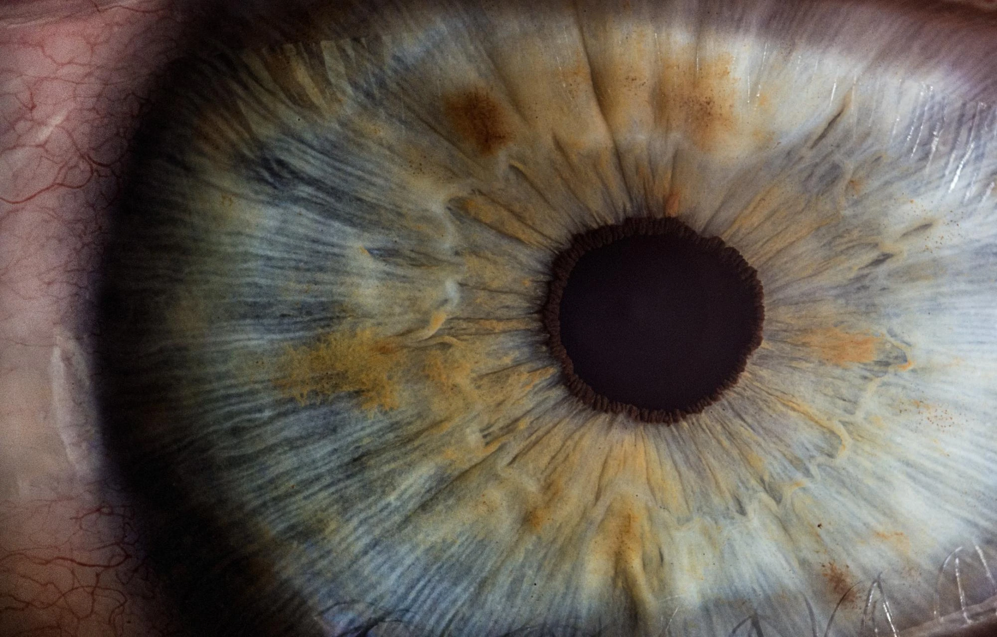 A Closer Look at Cataracts A Closer Look at Cataracts
