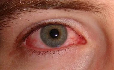 Viral Conjunctivitis